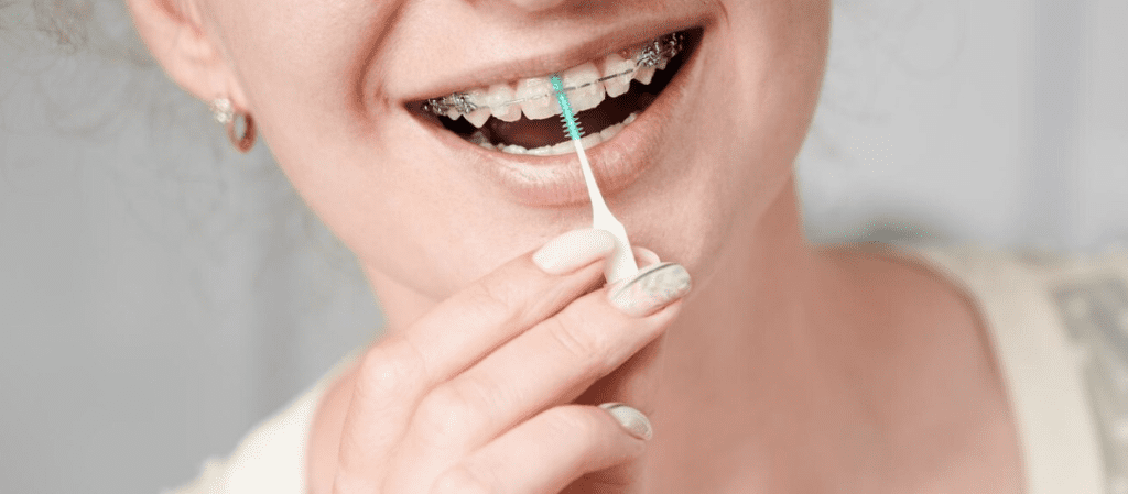 How Do I Care For My Teeth While Wearing Braces?